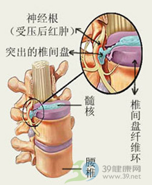 病例分析脊髓型頸椎病