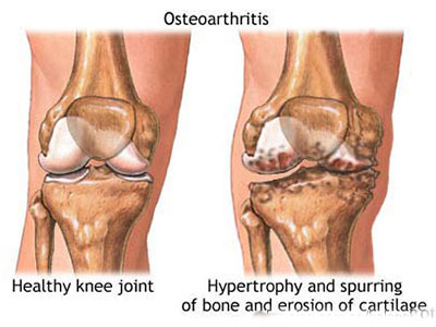 骨關節炎的分類您知道嗎