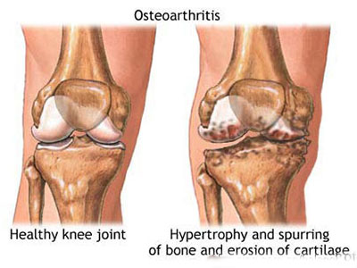 膝關節炎，人類無法逾越的身體問題 