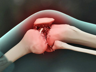 膝關節炎有3種類型，40歲以上最易中招！