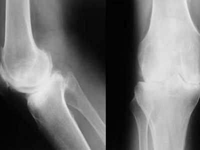 膝關節骨性關節炎“階梯性”治療是關鍵