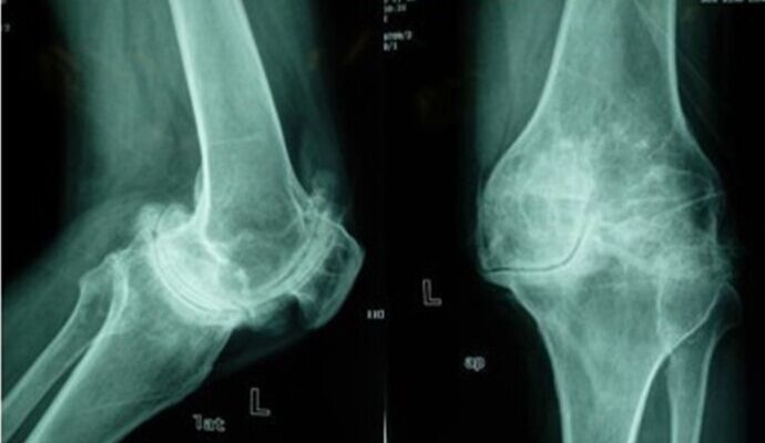 得了骨性關節炎怎麼治療 關節怎麼保健