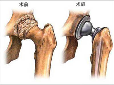 股骨頭壞死的常規治療