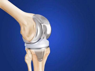 膝關節炎的臨床表現 治療膝關節炎的3個方法