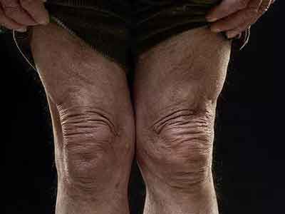 老人家不可輕視膝關節炎 或引起殘疾