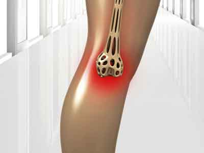 膝關節炎的保健方法