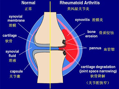 膝關節創傷性滑膜炎簡介