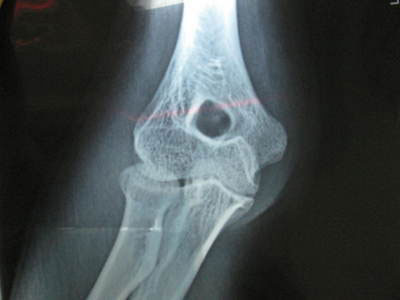 膝關節炎：人類健康的一大天敵