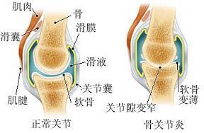 怎麼選擇膝關節骨性關節炎治療方法