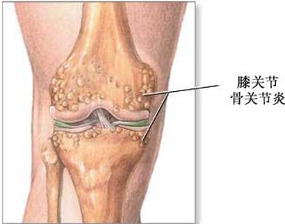 中老年人如何應對骨性關節炎