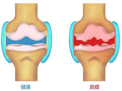 細說老年常見病——骨關節炎