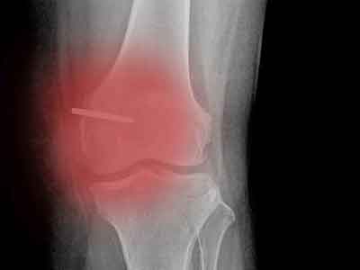 用自己的細胞可治好自己的膝骨關節炎