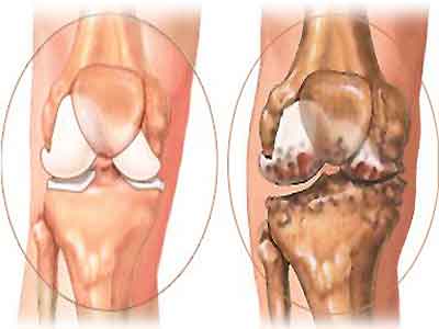 膝關節炎是什麼？老年人尤其注意