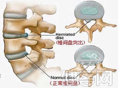 預防關節炎的“中醫四寶”