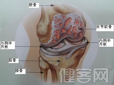 膝關節疼痛謹防膝骨關節炎