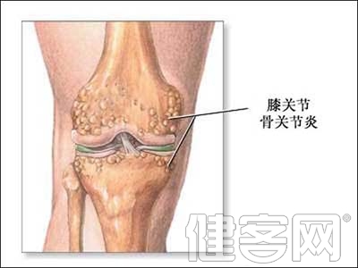 骨關節炎患者多做運動有好處