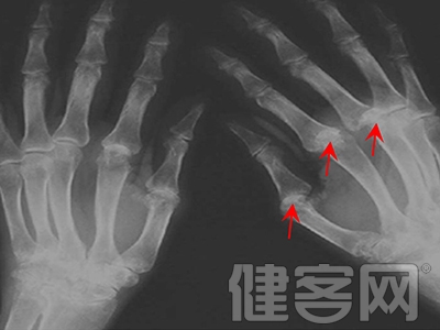 以為關節扭傷 原是痛風性關節炎