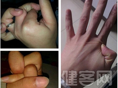 網傳掰手指會引發關節炎，專家澄清非也