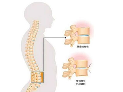 頸椎病是否會引起肩胛骨疼痛？