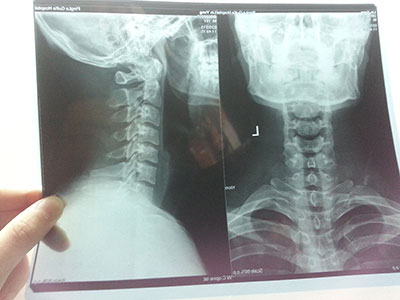 輕信頸椎病防治方法小心走進誤區