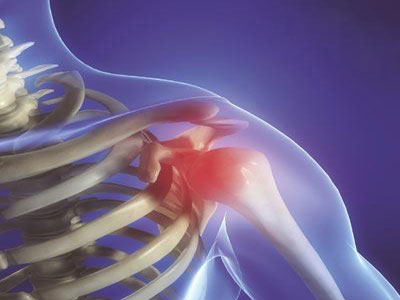 肩周炎與肩關節疼痛症狀的區別
