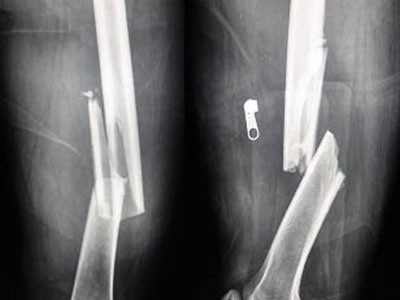 骨折——骨折段的移位