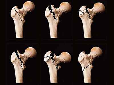 骨折久不愈合小心是骨不連 治療骨不連通常怎樣操作