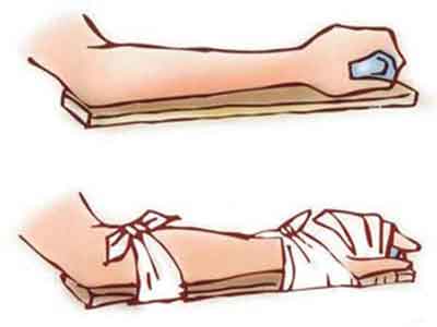 石膏固定法如何治療骨折