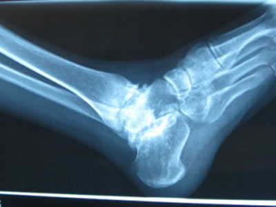 踝關節骨折的分型和治療