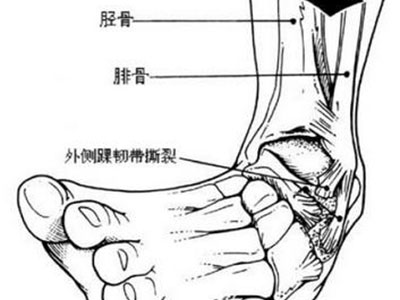 盤點跟骨骨折的發病原因