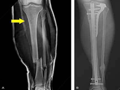 小腿骨折是最常見的骨折