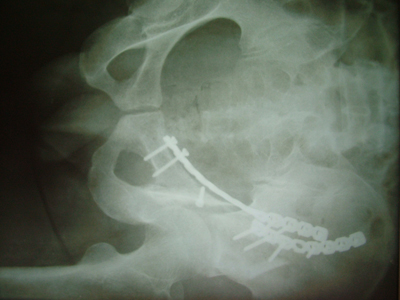 股骨粗隆間骨折是什麼原因引起的？