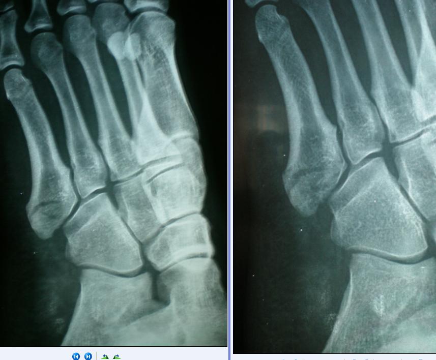 跖骨骨折有哪些檢查與診斷方法呢？