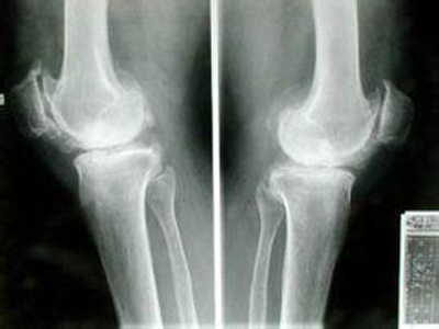 無移位跖骨骨折的治療方法