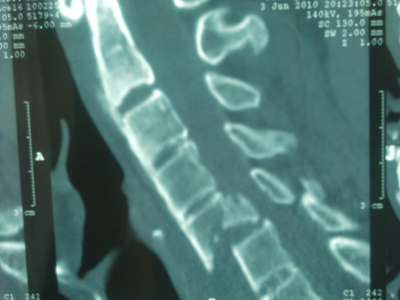 肱骨外科頸骨折有哪些臨床症狀呢？
