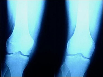 外傷導致骨頭的錯位導致成為孟氏骨折