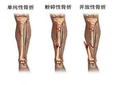 骨折在日常生活中的預防保健措施