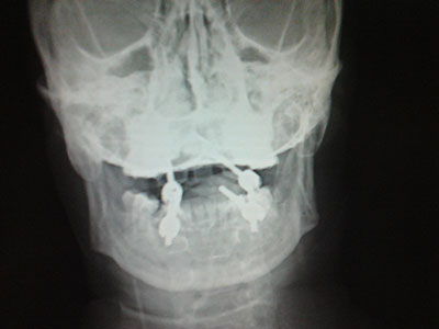 伴齒狀突骨折是怎麼回事你知道嗎？