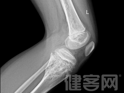 20歲開始預防骨質疏松已經晚了