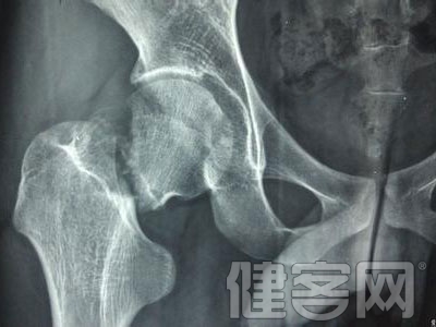 鎖骨骨折一般可以看出局部腫脹