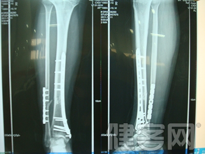 骨折的急救方法及固定技巧