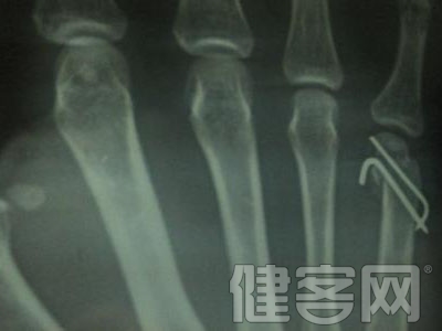 不同位置骨折的愈合時間不同