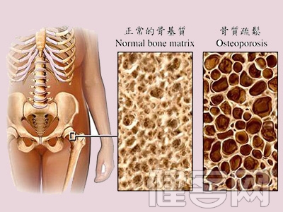 為什麼冬季骨折病人明顯增多？