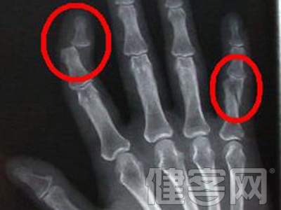 小拇指骨折要多久恢復 需要注意些什麼