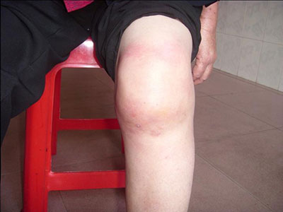 大家了解什麼是膝蓋骨質增生嗎？