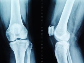 骨質增生與骨刺區別有哪些