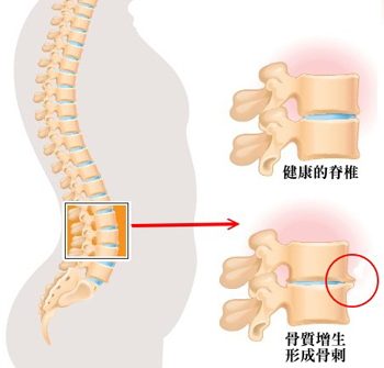 骨質增生的常見問題