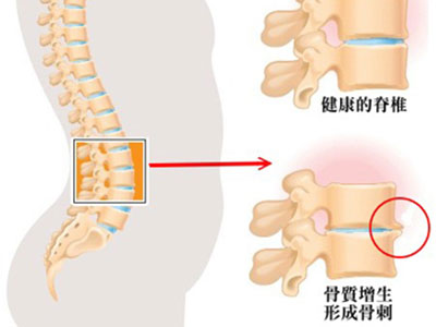 骨質增生患者你需要了解這些