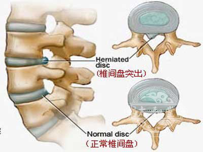 脊椎的骨質增生會不會造成癱瘓呢？