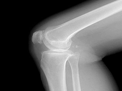 膝關節骨質增生的預防可從八方面入手